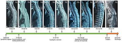 Intracranial Metastases Originating From Pediatric Primary Spinal Cord Glioblastoma Multiforme: A Case Report and Literature Review